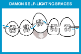 The Damon® System